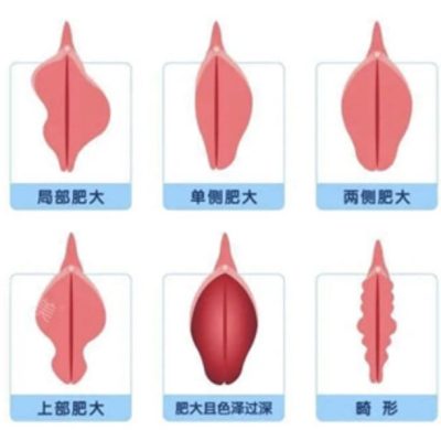 局部、单侧、两侧、上部、畸形等六种入玉门的图片高清大图