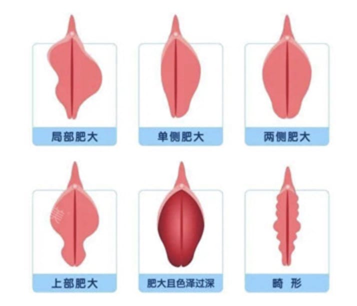 局部、单侧、两侧、上部、畸形等六种入玉门的图片高清大图_1